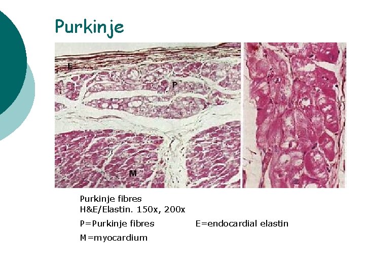 Purkinje fibres H&E/Elastin. 150 x, 200 x P=Purkinje fibres M=myocardium E=endocardial elastin 