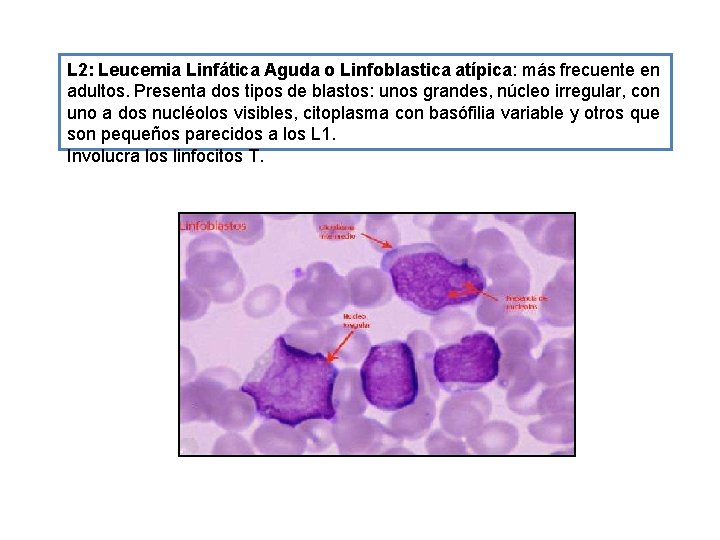 L 2: Leucemia Linfática Aguda o Linfoblastica atípica: más frecuente en adultos. Presenta dos