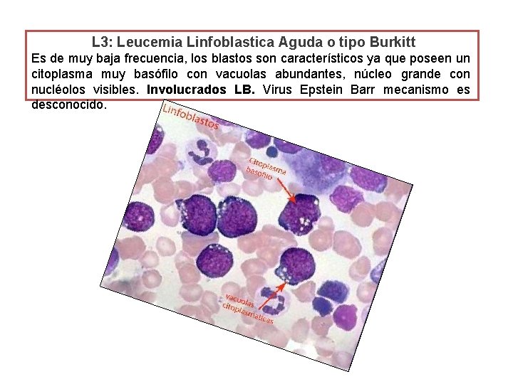 L 3: Leucemia Linfoblastica Aguda o tipo Burkitt Es de muy baja frecuencia, los