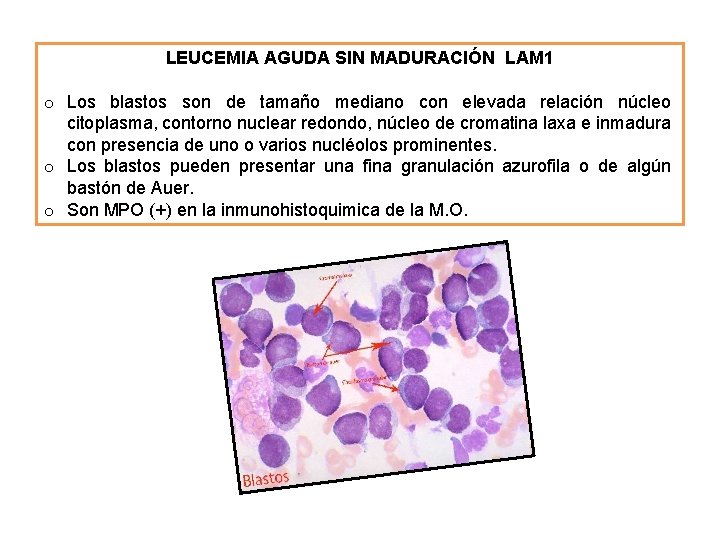 LEUCEMIA AGUDA SIN MADURACIÓN LAM 1 o Los blastos son de tamaño mediano con