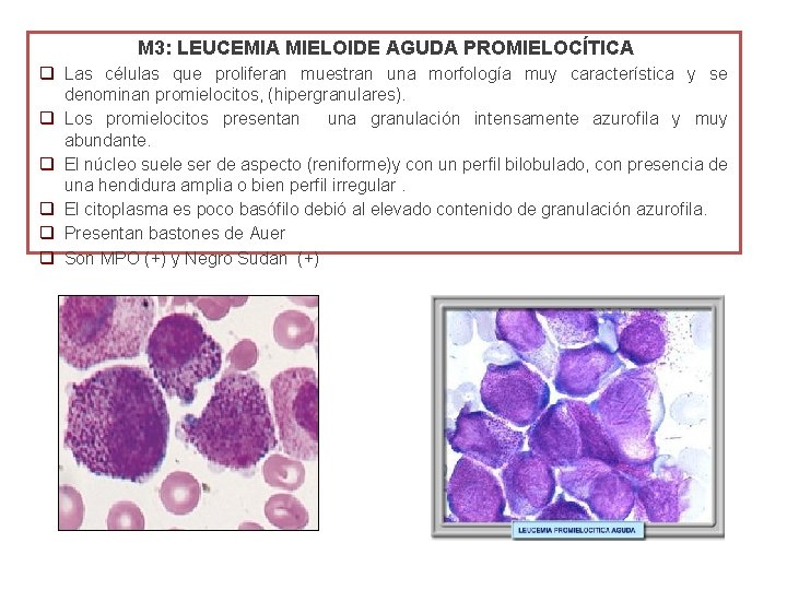 M 3: LEUCEMIA MIELOIDE AGUDA PROMIELOCÍTICA q Las células que proliferan muestran una morfología