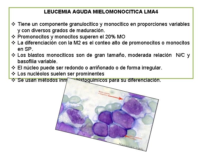 LEUCEMIA AGUDA MIELOMONOCITICA LMA 4 v Tiene un componente granulocitico y monocitico en proporciones