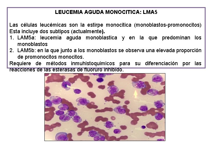 LEUCEMIA AGUDA MONOCITICA: LMA 5 Las células leucémicas son la estirpe monocitica (monoblastos-promonocitos) Esta