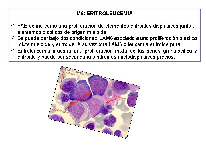 M 6: ERITROLEUCEMIA ü FAB define como una proliferación de elementos eritroides displasicos junto