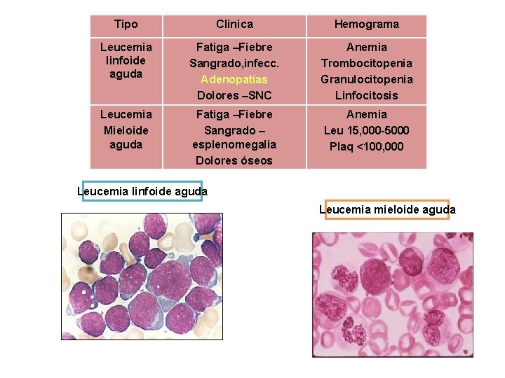 Tipo Clínica Hemograma Leucemia linfoide aguda Fatiga –Fiebre Sangrado, infecc. Adenopatías Dolores –SNC Anemia