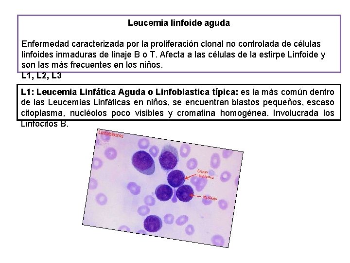 Leucemia linfoide aguda Enfermedad caracterizada por la proliferación clonal no controlada de células linfoides