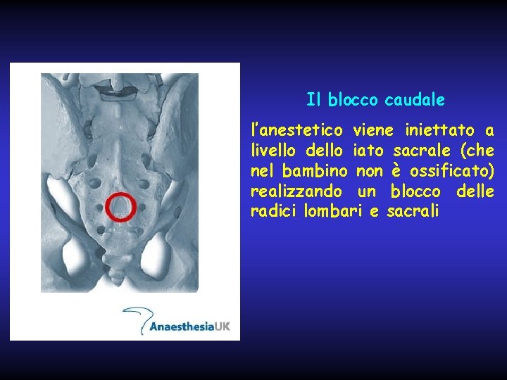 Il blocco caudale l’anestetico viene iniettato a livello dello iato sacrale (che nel bambino