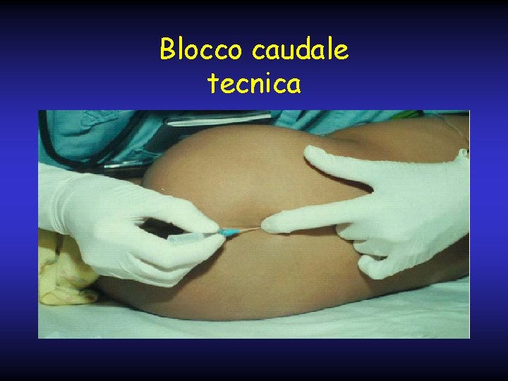 Blocco caudale tecnica 