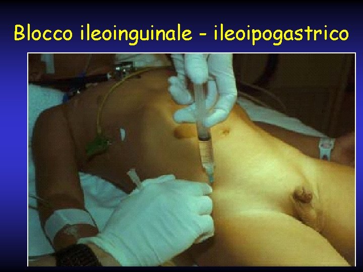 Blocco ileoinguinale - ileoipogastrico 