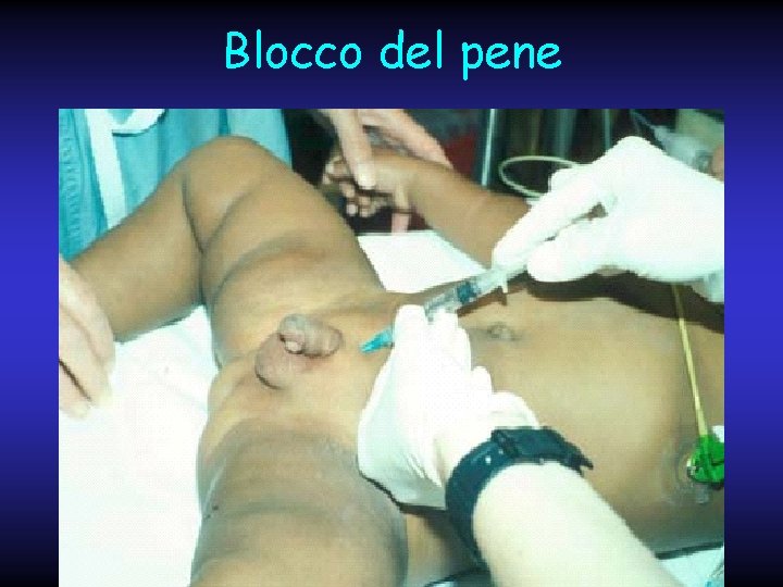 Blocco del pene 