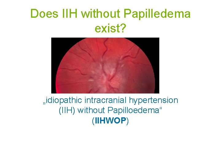 Does IIH without Papilledema exist? „idiopathic intracranial hypertension (IIH) without Papilloedema“ (IIHWOP) 