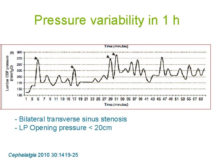 Pressure variability in 1 h - Bilateral transverse sinus stenosis - LP Opening pressure