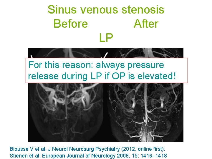 Sinus venous stenosis Before After LP For this reason: always pressure release during LP