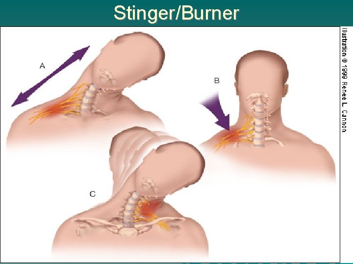 Stinger/Burner 