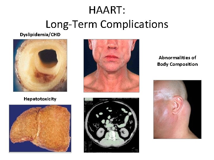 HAART: Long-Term Complications Dyslipidemia/CHD Abnormalities of Body Composition Hepatotoxicity 