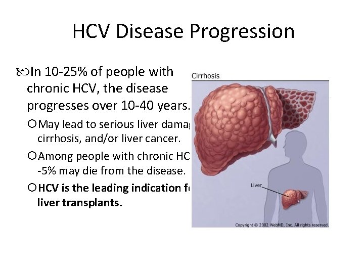 HCV Disease Progression In 10 -25% of people with chronic HCV, the disease progresses