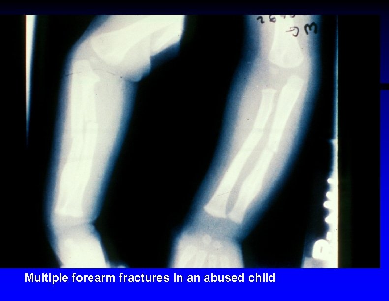 Multiple forearm fractures in an abused child 