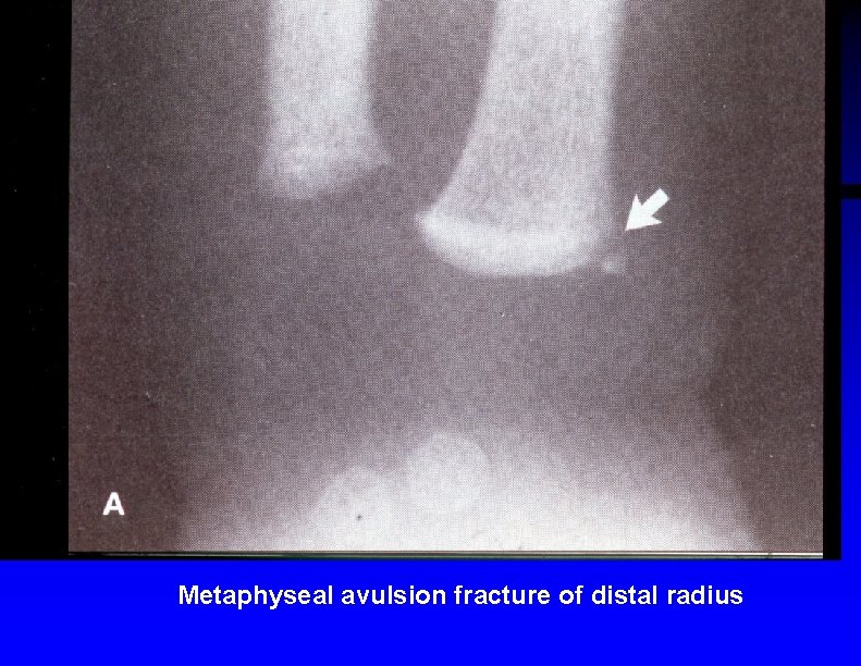 Metaphyseal avulsion fracture of distal radius 