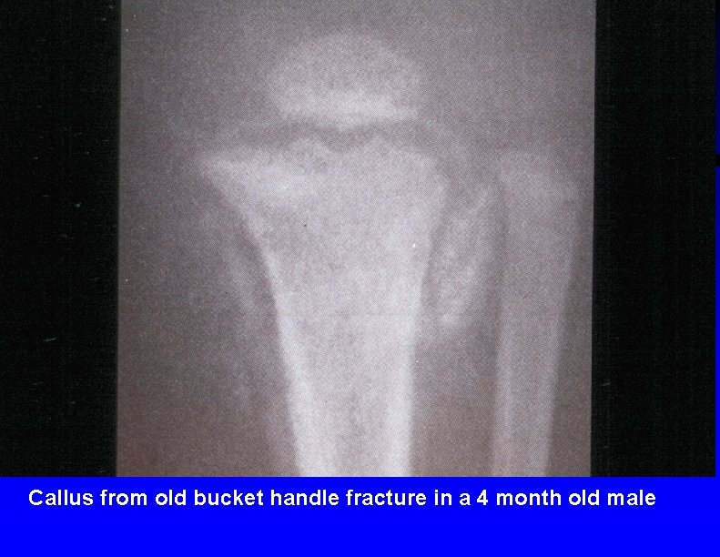 Callus from old bucket handle fracture in a 4 month old male 