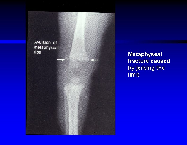Metaphyseal fracture caused by jerking the limb 