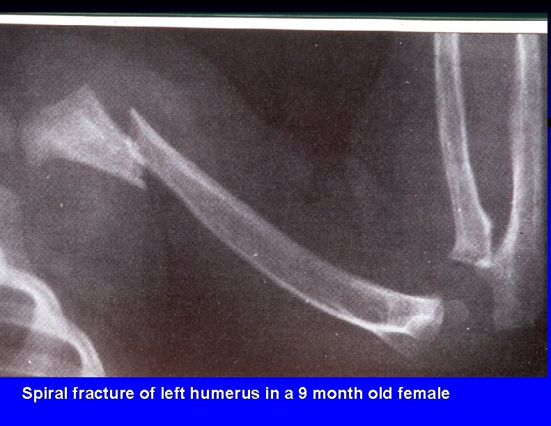 Spiral fracture of left humerus in a 9 month old female 