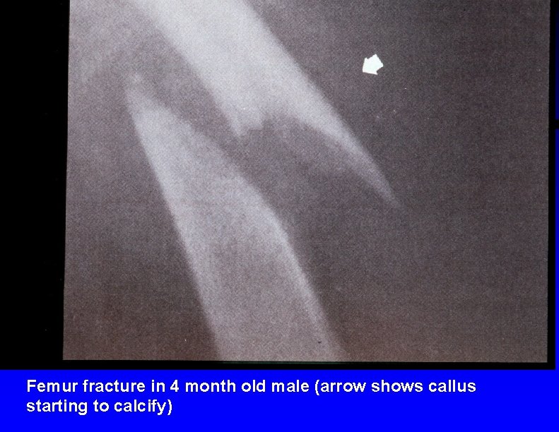 Femur fracture in 4 month old male (arrow shows callus starting to calcify) 