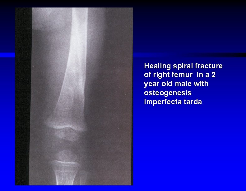 Healing spiral fracture of right femur in a 2 year old male with osteogenesis