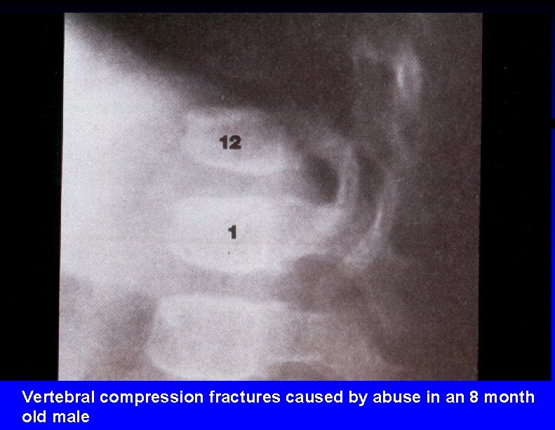 Vertebral compression fractures caused by abuse in an 8 month old male 