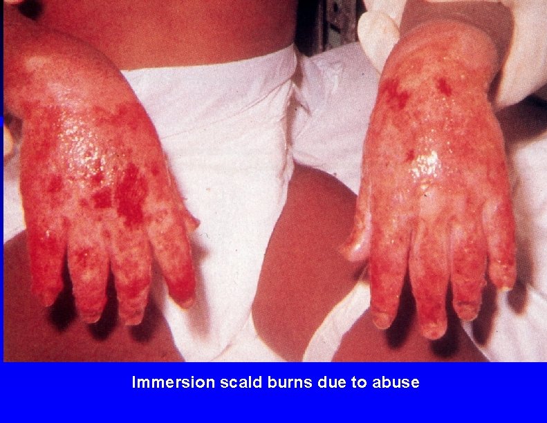 Immersion scald burns due to abuse 