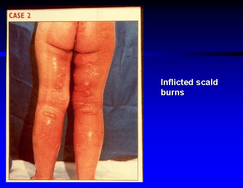 Inflicted scald burns 