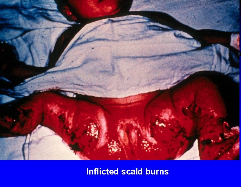 Inflicted scald burns 