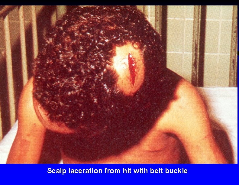 Scalp laceration from hit with belt buckle 