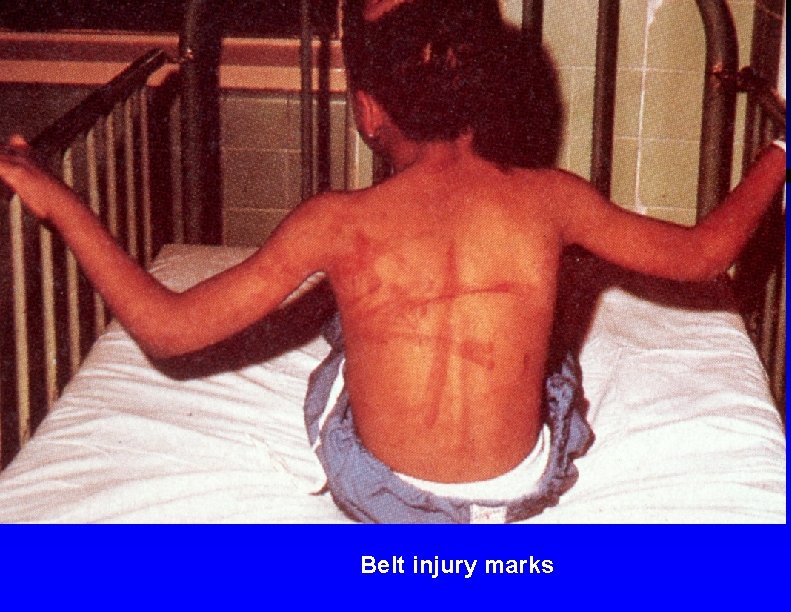Belt injury marks 