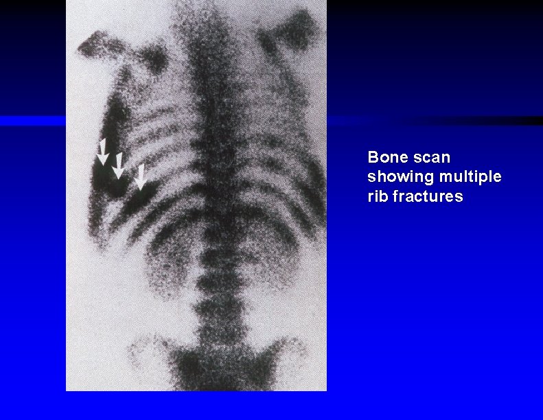 Bone scan showing multiple rib fractures 