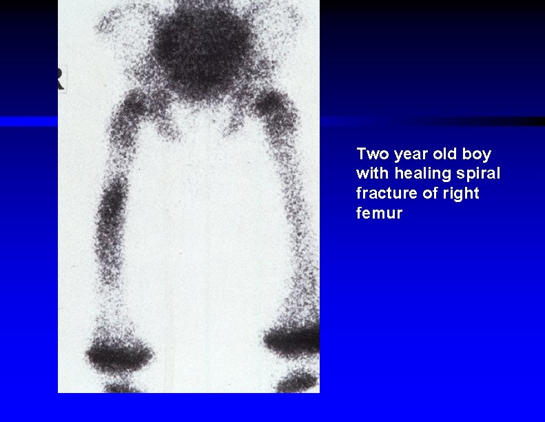 Two year old boy with healing spiral fracture of right femur 