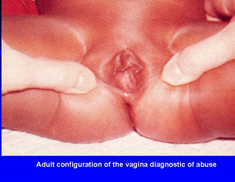 Adult configuration of the vagina diagnostic of abuse 
