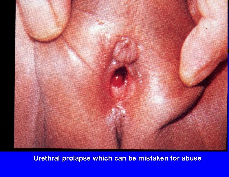 Urethral prolapse which can be mistaken for abuse 