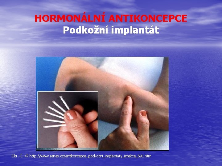 HORMONÁLNÍ ANTIKONCEPCE Podkožní implantát Obr. Č. 47 http: //www. zenax. cz/antikoncepce_podkozni_implantaty_injekce_691. htm 