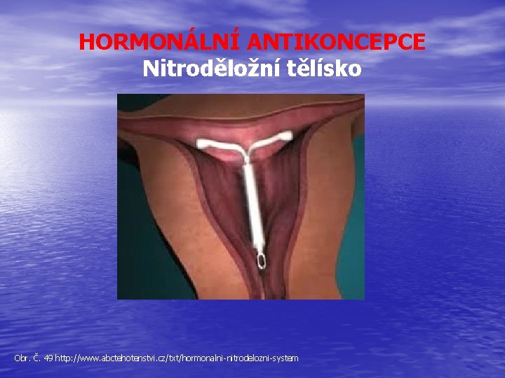 HORMONÁLNÍ ANTIKONCEPCE Nitroděložní tělísko Obr. Č. 49 http: //www. abctehotenstvi. cz/txt/hormonalni-nitrodelozni-system 