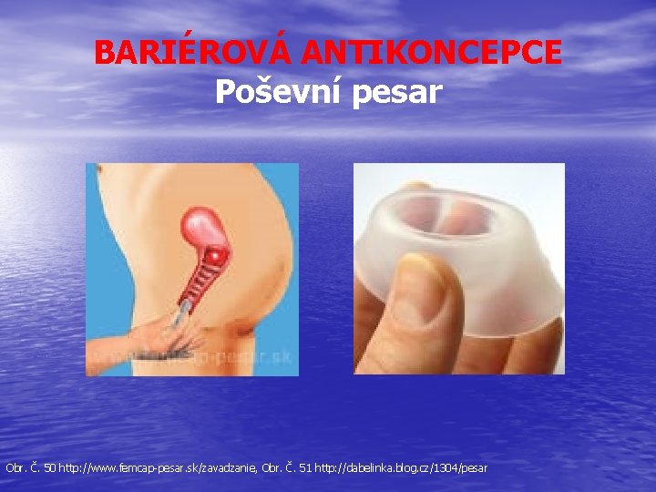 BARIÉROVÁ ANTIKONCEPCE Poševní pesar Obr. Č. 50 http: //www. femcap-pesar. sk/zavadzanie, Obr. Č. 51