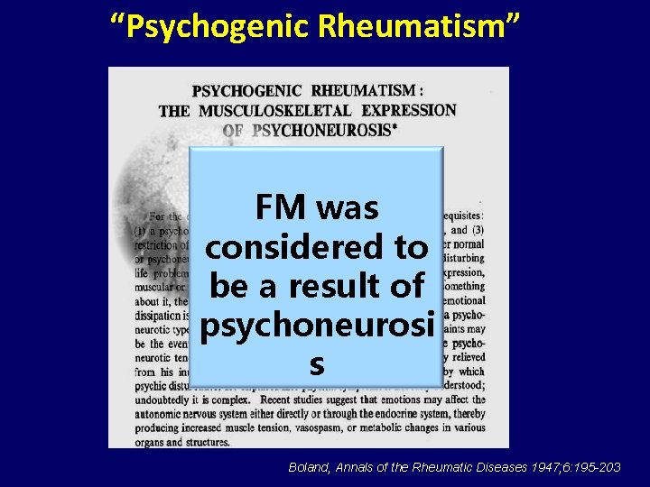 “Psychogenic Rheumatism” FM was considered to be a result of psychoneurosi s Boland, Annals