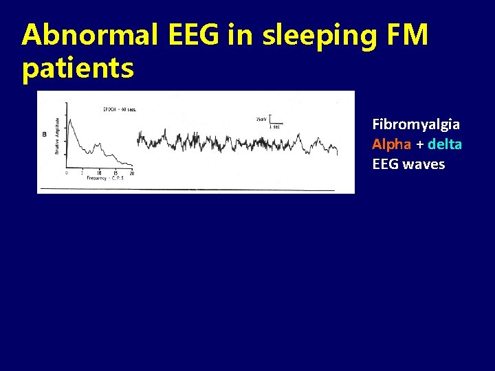 Abnormal EEG in sleeping FM patients Fibromyalgia Alpha + delta EEG waves Sleep disruption