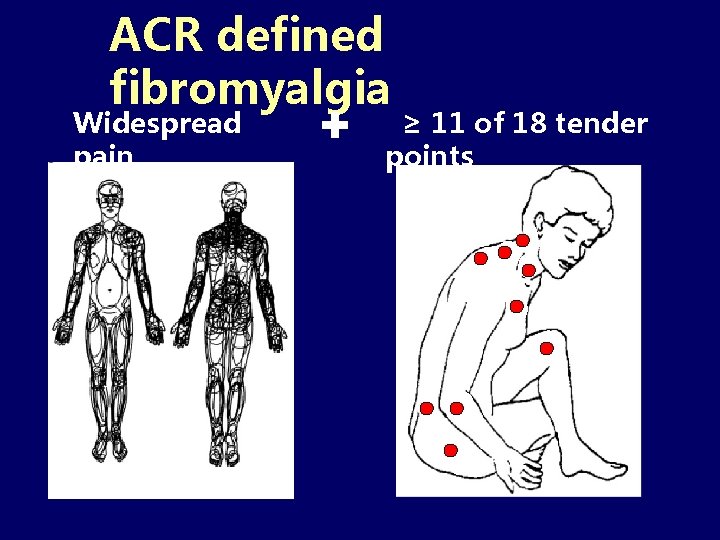ACR defined fibromyalgia Widespread pain + ≥ 11 of 18 tender points 