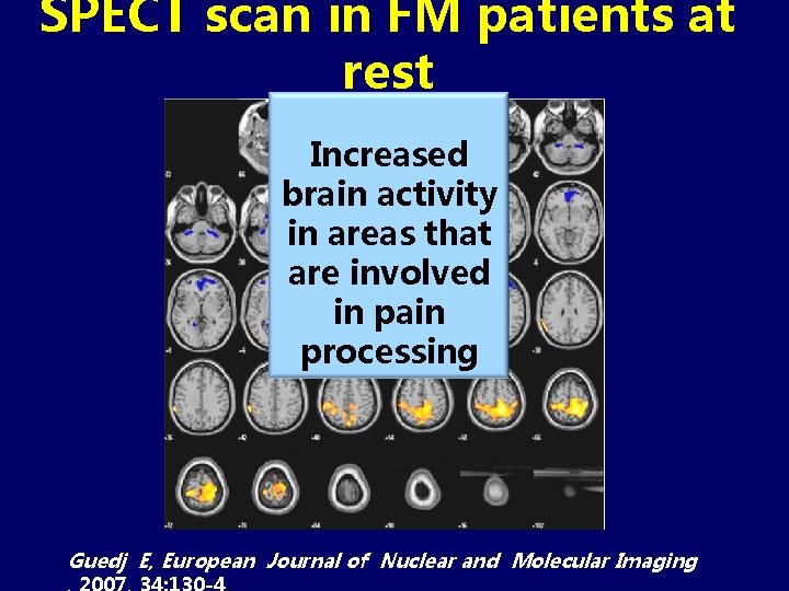 SPECT scan in FM patients at rest Increased brain activity in areas that are