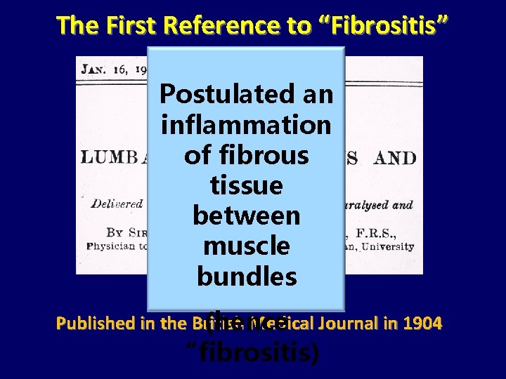 The First Reference to “Fibrositis” Postulated an inflammation of fibrous tissue between muscle bundles