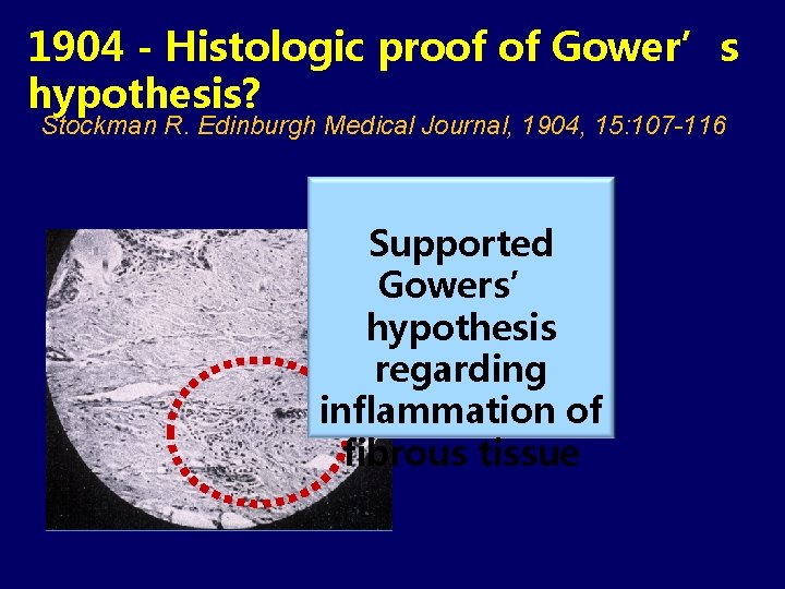 1904 - Histologic proof of Gower’s hypothesis? Stockman R. Edinburgh Medical Journal, 1904, 15: