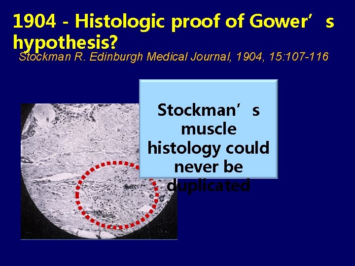 1904 - Histologic proof of Gower’s hypothesis? Stockman R. Edinburgh Medical Journal, 1904, 15: