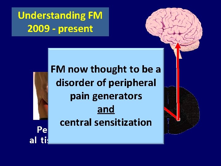 Understanding FM 2009 - present FM now thought to be a disorder of peripheral