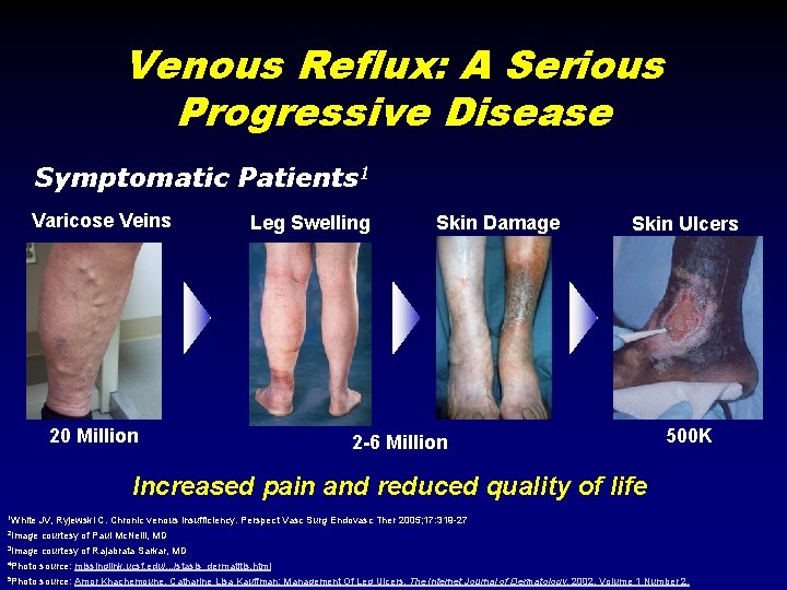 Venous Reflux: A Serious Progressive Disease Symptomatic Patients 1 Varicose Veins Leg Swelling 20