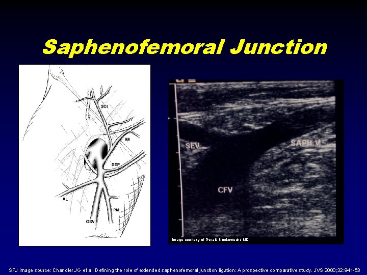 Saphenofemoral Junction Image courtesy of Gerald Niedzwiecki, MD SFJ image source: Chandler JG et